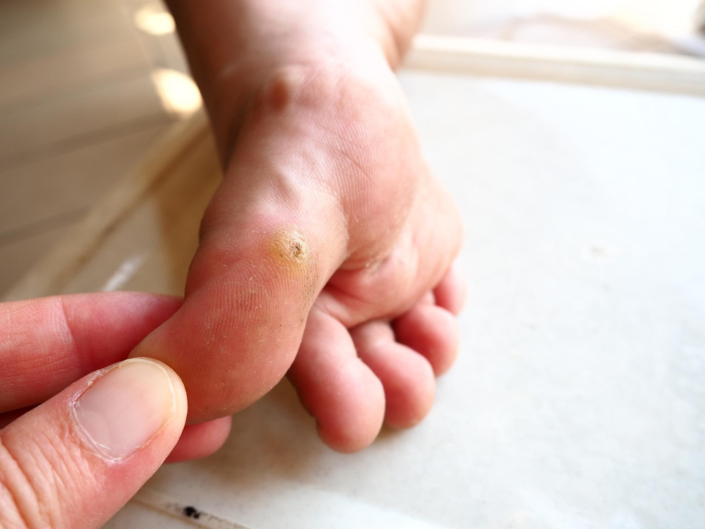 Warts